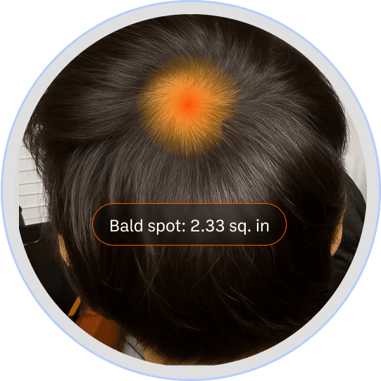 Bald spot progression