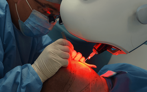 Robotic Hair Transplant