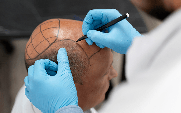 FUT Hair Transplant