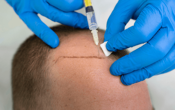 Platelet-Rich Plasma (PRP)