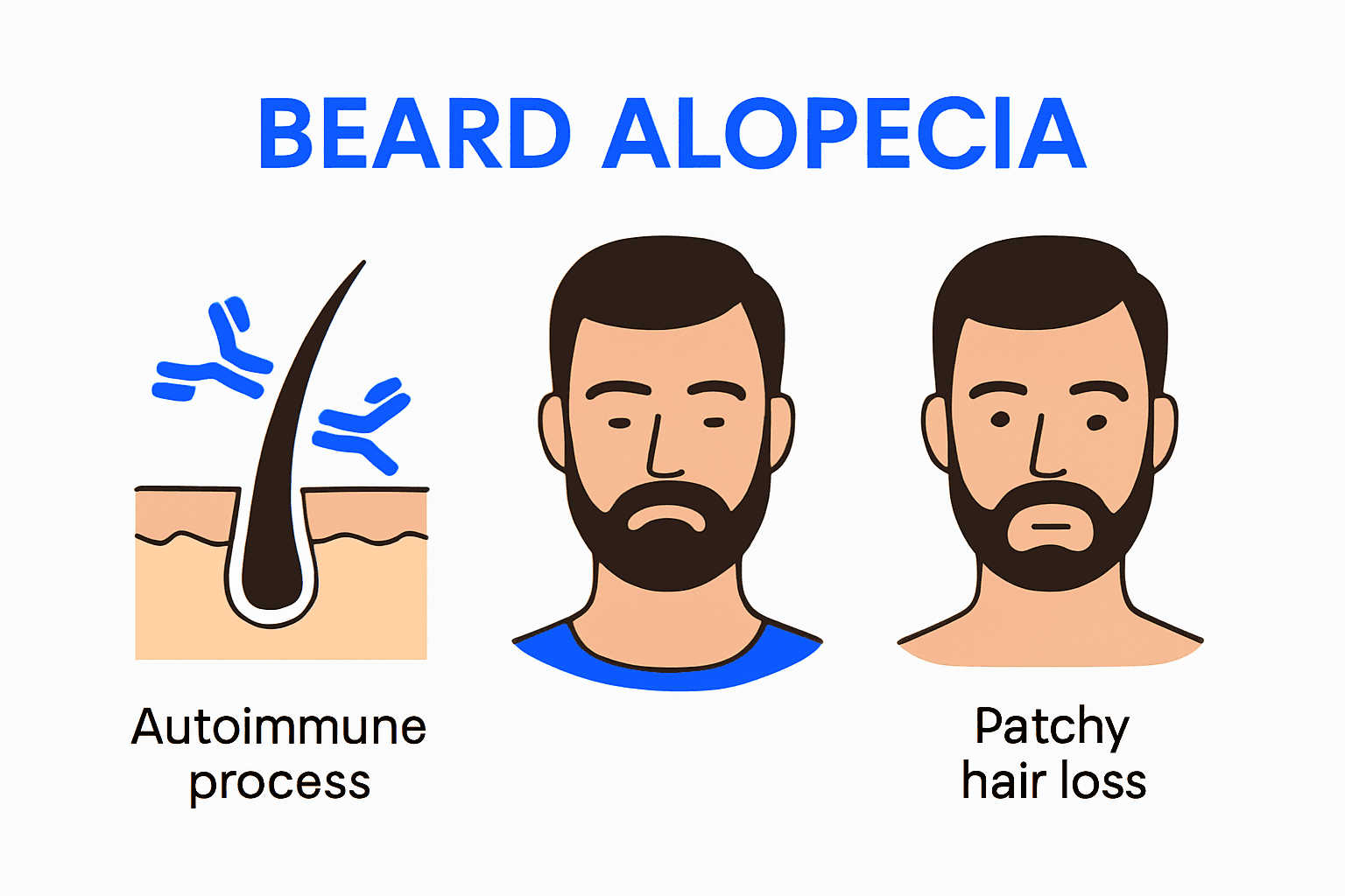 Diagram of beard alopecia causes and symptoms