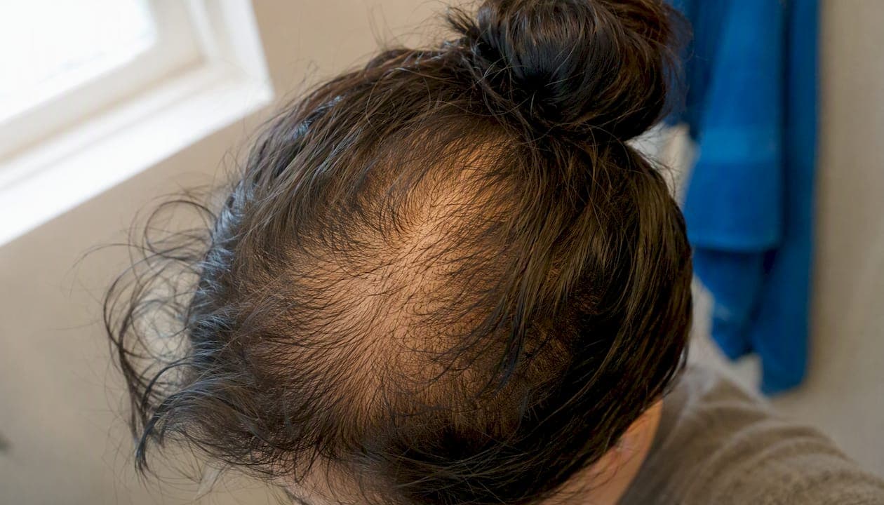 Close-up scalp showing miniaturized hair follicles