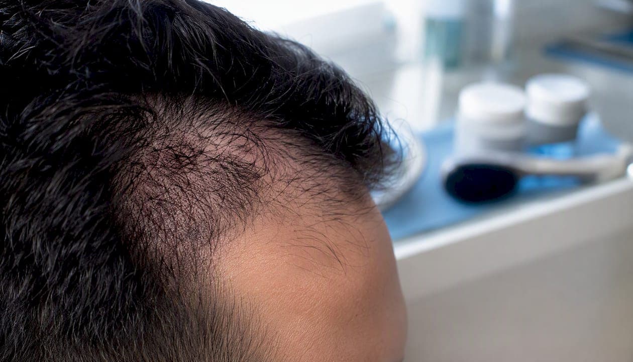 Close-up of hair follicles on scalp skin