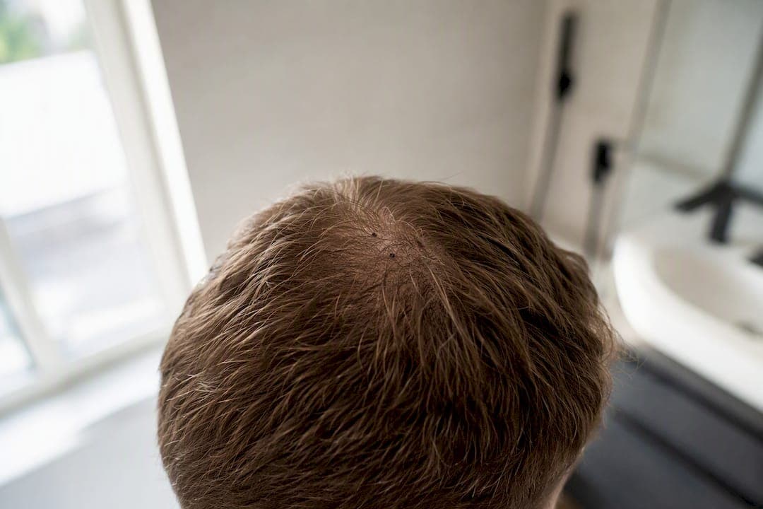 Nahaufnahme der Kopfhaut mit eingezeichneten Orientierungspunkten