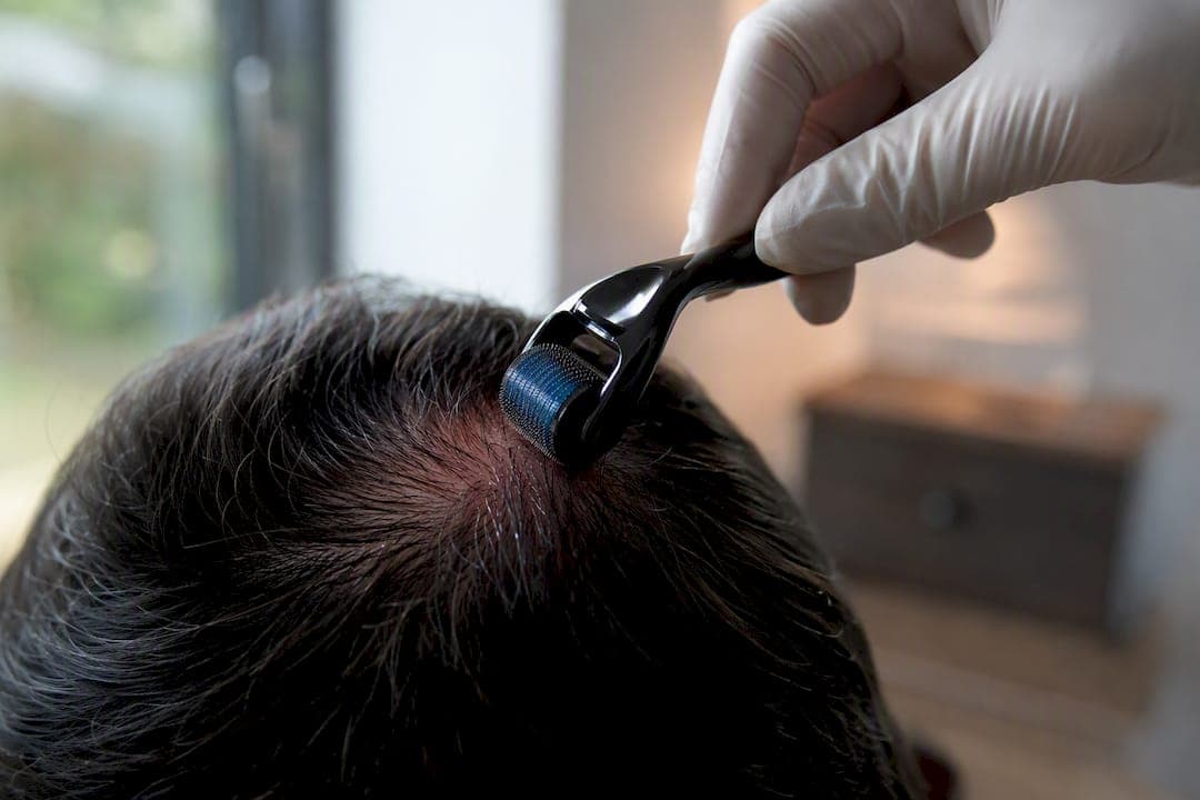 Nahaufnahme von Microneedling-Nadeln auf der Kopfhaut