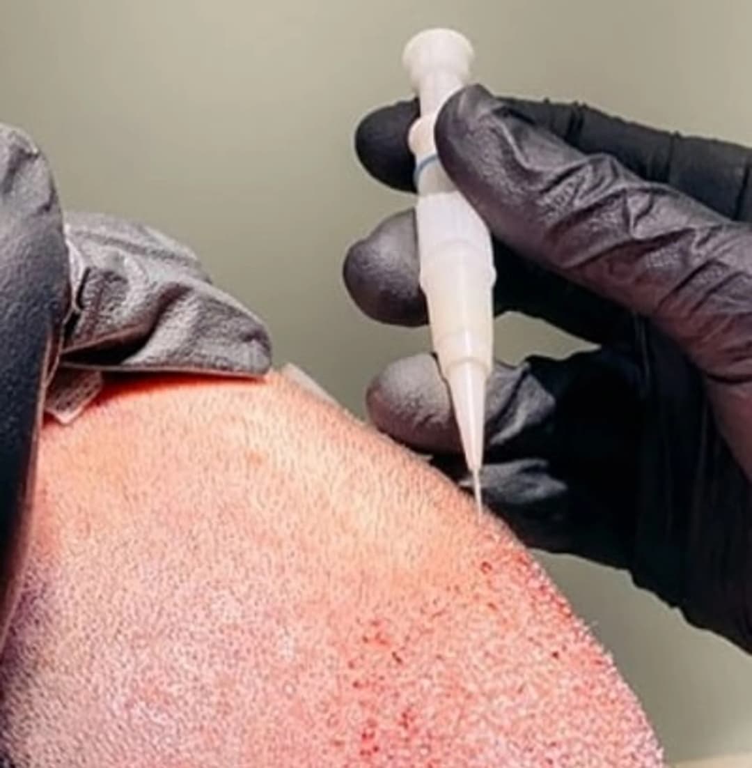 Μεταμόσχευση Μαλλιών reGrow Hair Clinic clinic 2